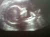 20_week_scan